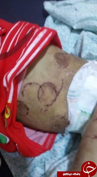 بدن بچه بیچاره