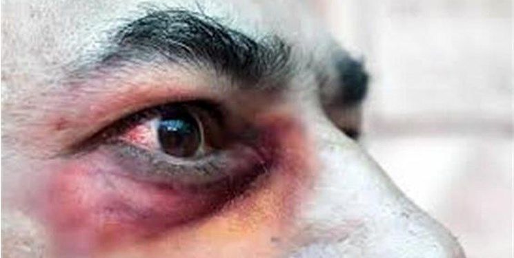 چکار کنیم به «قارچ سیاه» مبتلا نشویم؟