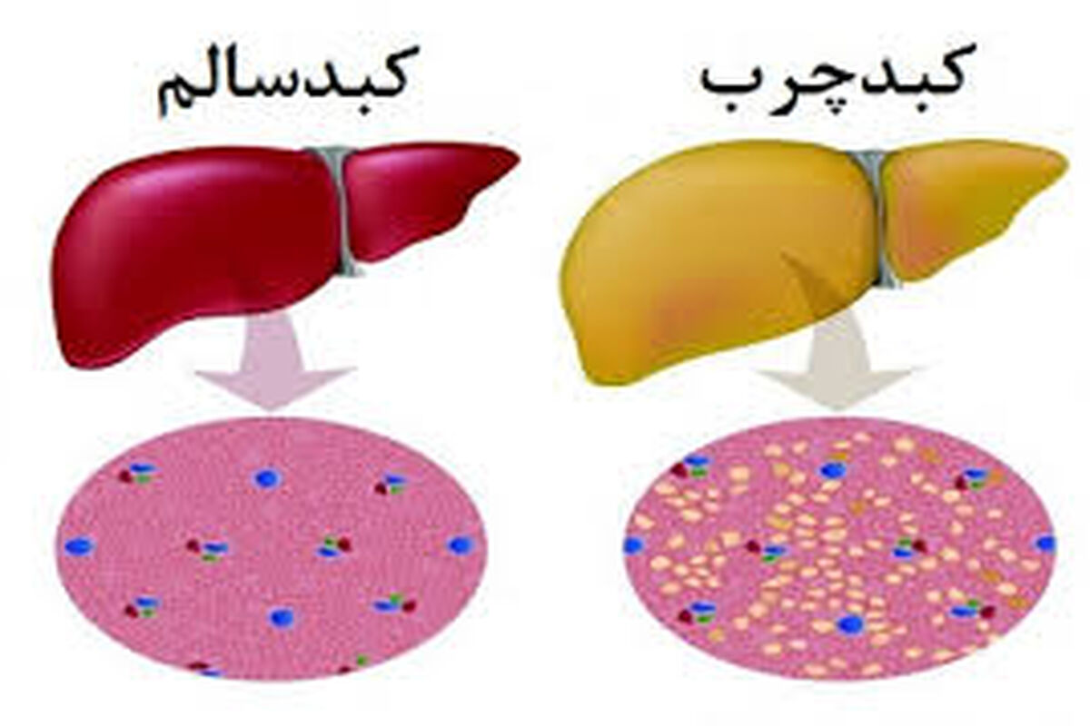 نوشیدنی‌هایی که کبد را چرب می‌کنند