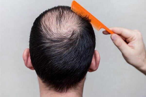 آیا مکمل «بیوتین» در جلوگیری از ریزش مو موثر است؟