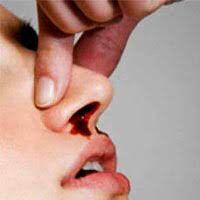 چرا هنگام خونریزی بینی نباید سر خود را بالا گرفت؟