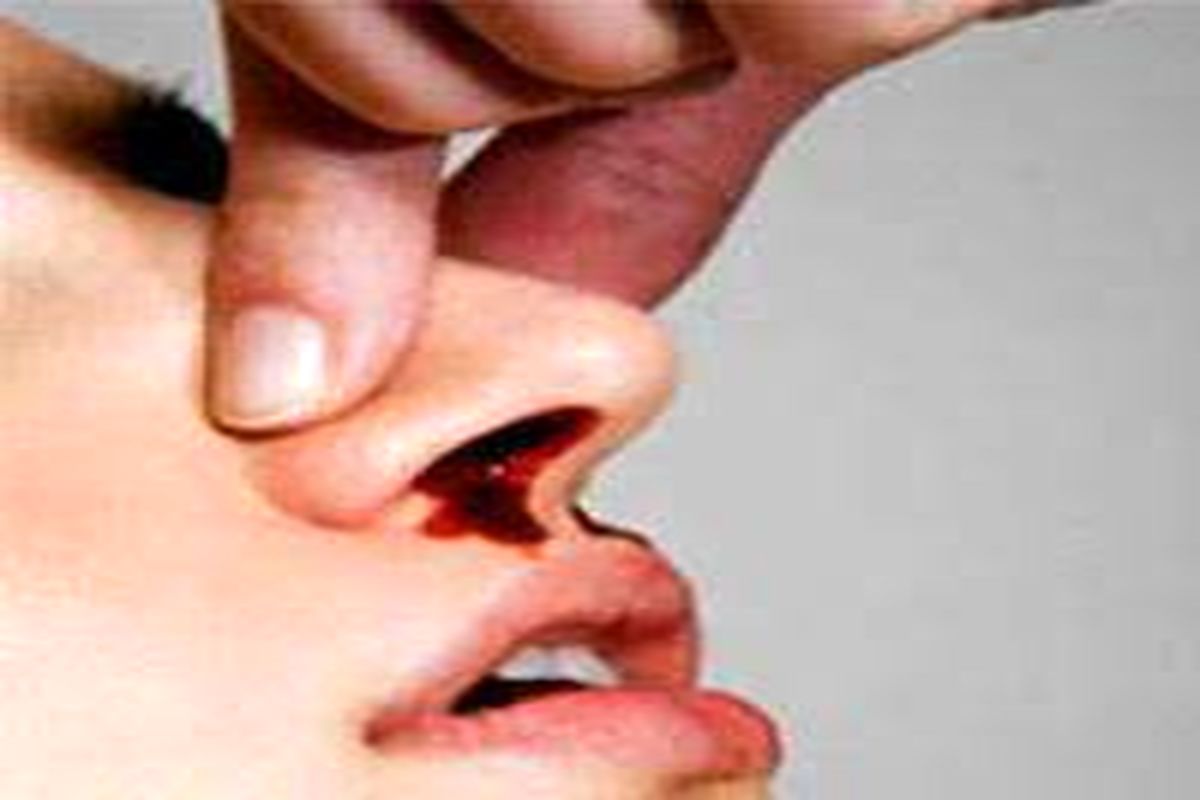چرا هنگام خونریزی بینی نباید سر خود را بالا گرفت؟