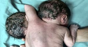 تولد یک نوزاد 2 سر با 3 تا دست/ عکس +18