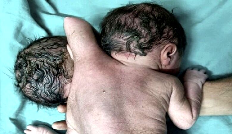 تولد یک نوزاد 2 سر با 3 تا دست/ عکس +18