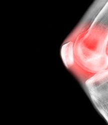 اقداماتی که برای مبتلایان به آرتروز باید انجام شود