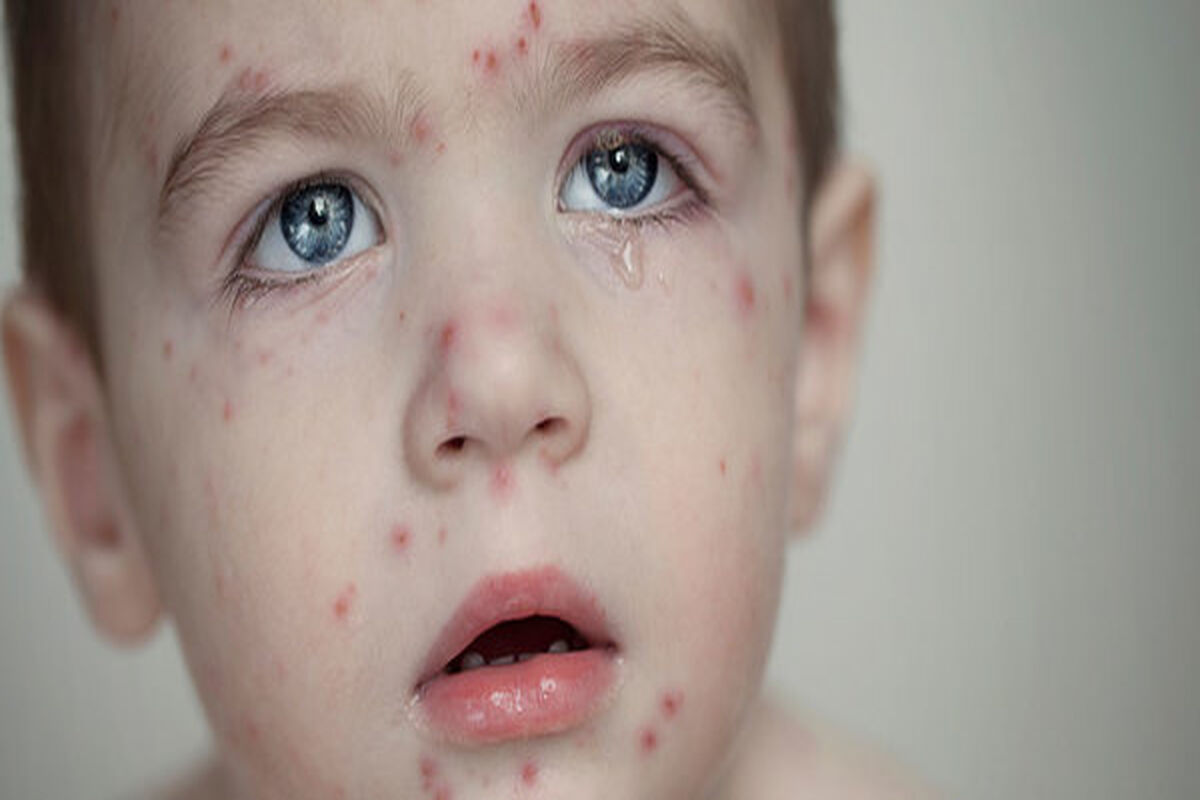 رژیم غذایی مناسب برای مبتلایان به آبله مرغان
