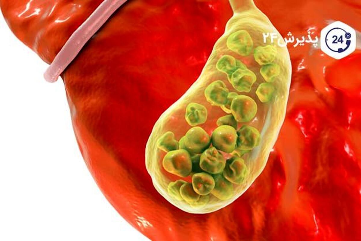 هشدار؛ با این علائم شما سنگ صفرا دارید!