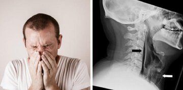 حادثه تکان دهنده برای یک مرد با نگهداشتن عطسه/ گلویش پاره شد + عکس