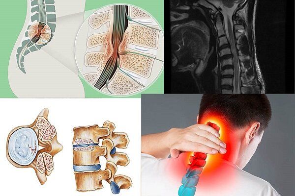 نشانه‌های تنگی کانال نخاعی گردن