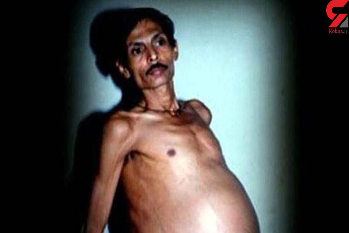 تولد نوزاد عجیب و ناقص الخلقه از شکم مرد هندی باردار + عکس ترسناک
