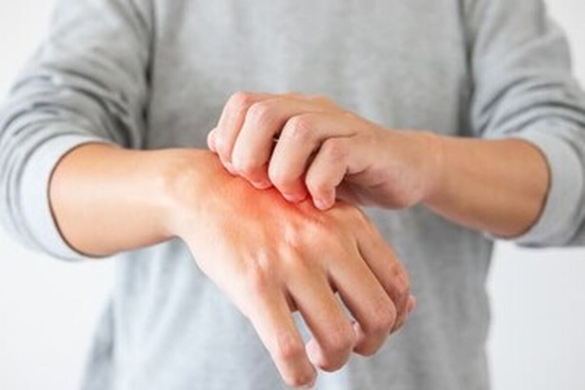 راه‌های پیشگیری از ابتلا به قارچ پوستی