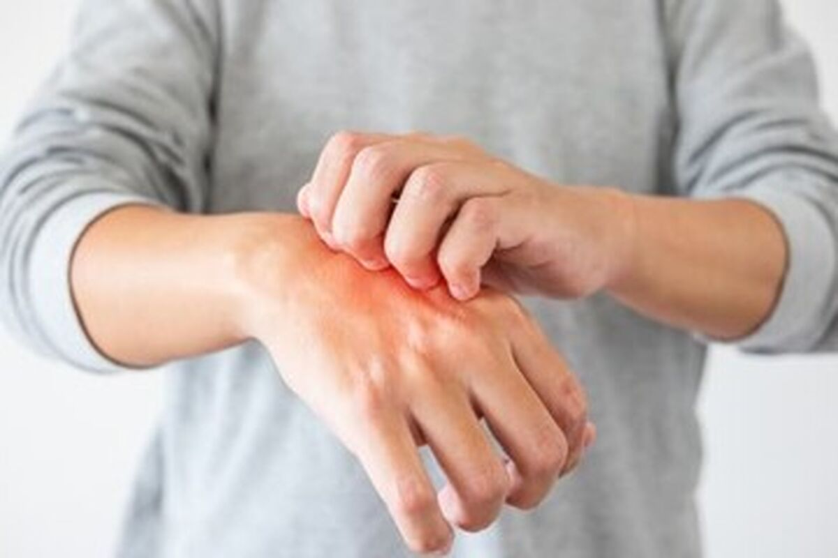 راه‌های پیشگیری از ابتلا به قارچ پوستی