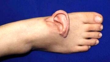 نجات لاله گوش زن جوان با پیوند موقت روی پا