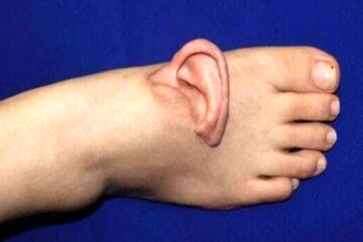 نجات لاله گوش زن جوان با پیوند موقت روی پا