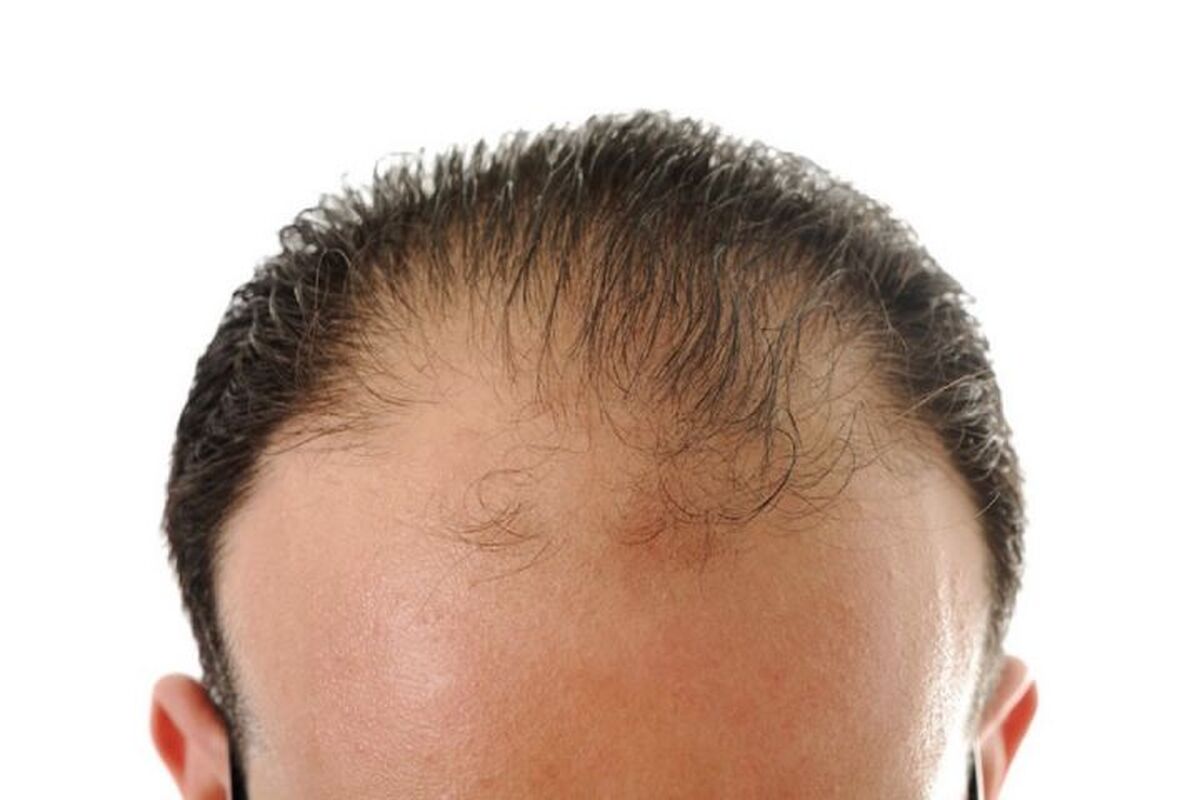 ویتامین جذاب برای جلوگیری از ریزش مو
