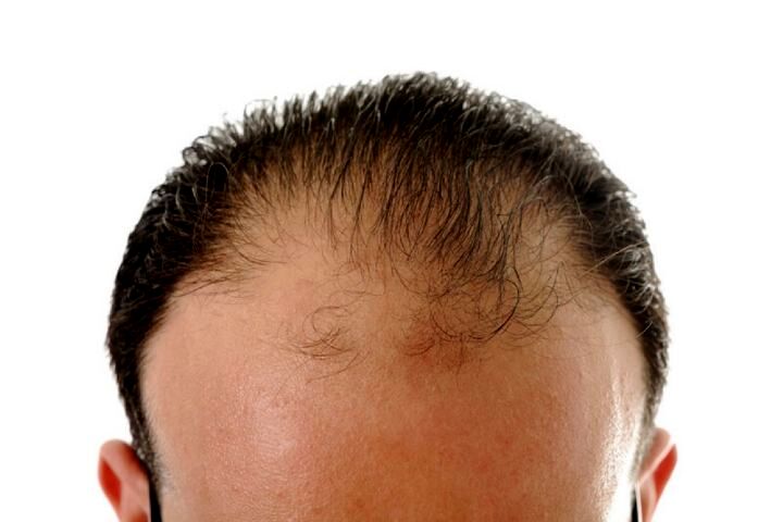 ترفندهای مناسب برای توقف ریزش مو