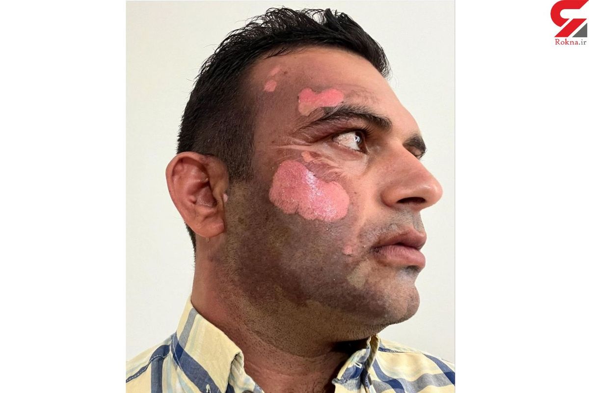 شکارچی غیرمجاز، محیط بان مازندرانی را سوزاند!/ عکس دلخراش از صورت محیط بان بیچاره + عکس