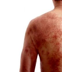 بیماری ترانه علیدوستی چیست و چه علائمی دارد؟