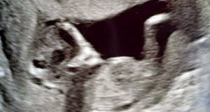 چشمان ترسناک یک جنین در شکم مادرش/ زن جوان شوکه شد! + عکس