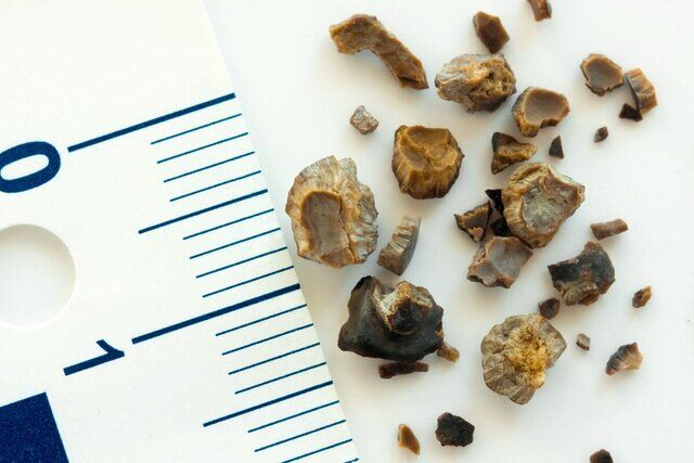 با این روش دیگر به سنگ کلیه دچار نمی شوید!