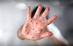 شیوع مجدد یک بیماری قدیمی!