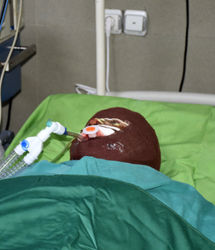 زن دیوانه که روی مرد جوان و دختر ۱۱ ساله‌اش اسید پاشی کرد