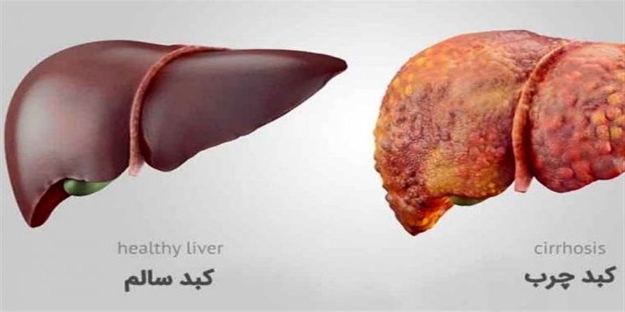 راهکارهایی برای درمان کبد چرب | مصرف این مواد غذایی را محدود کنید | این نوشیدنی‌ها برای کبد حکم سم را دارند