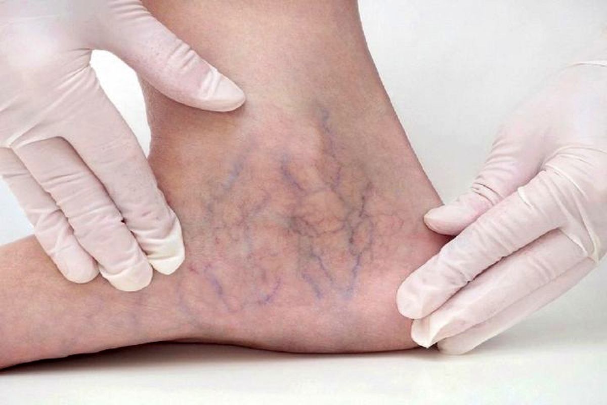 آشنایی با علائم و راه‌های درمان واریس