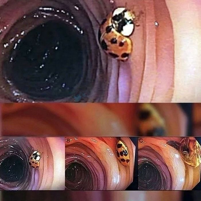 کشف عجیب حشره ای زنده داخل روده یک بیمار