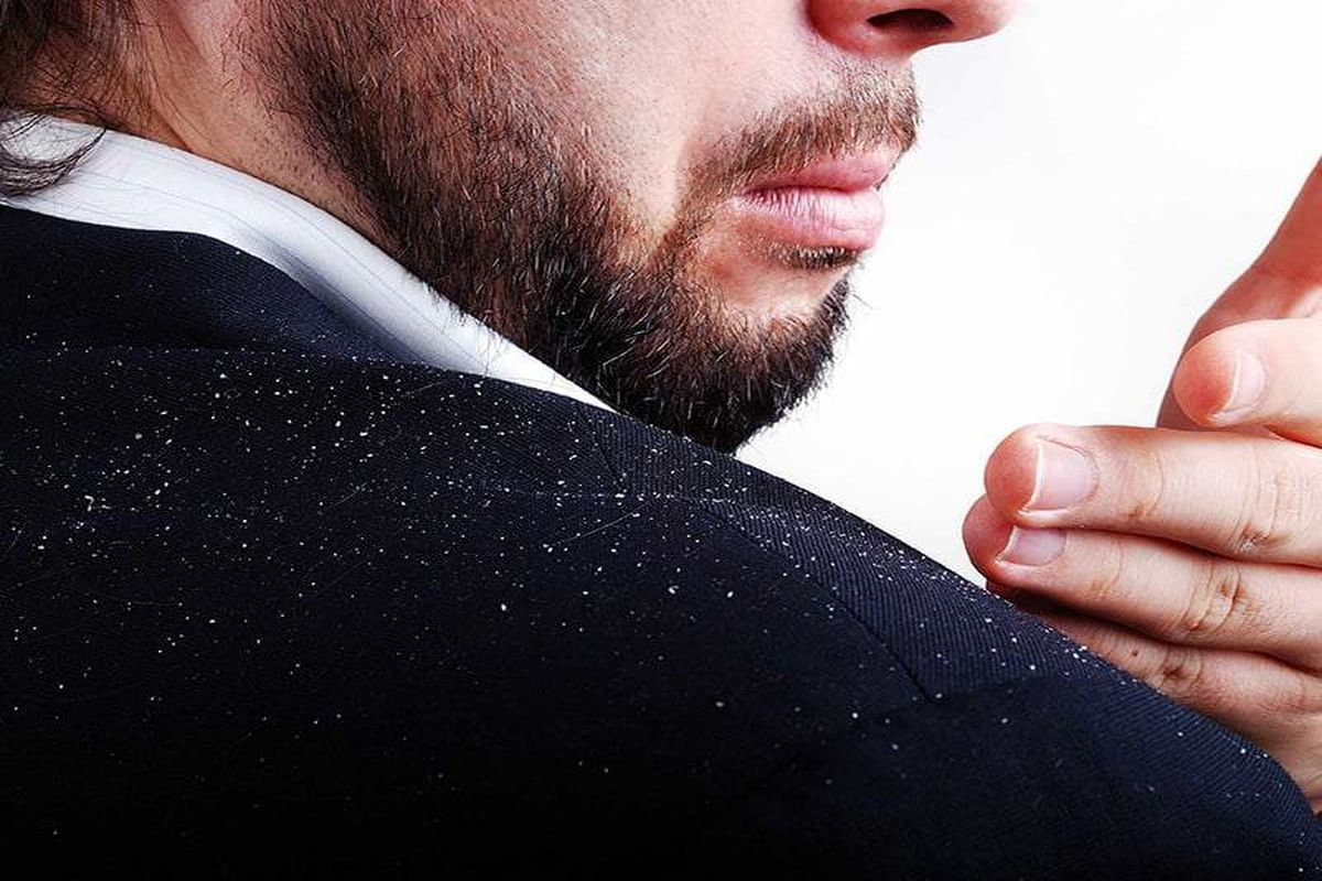 چرا شوره سر در زمستان بیشتر می‌شود؟