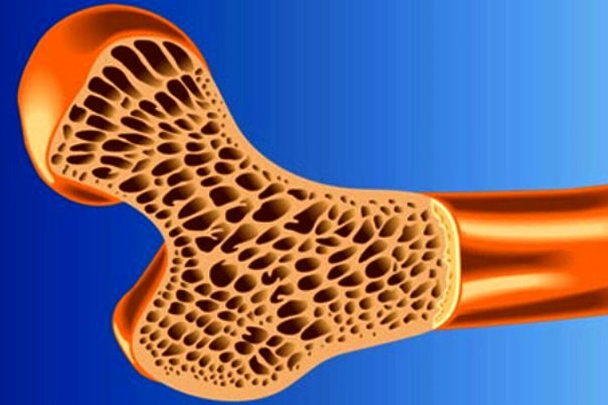 بهترین ویتامین برای پیشگیری از پوکی استخوان | تنها راه تشخیص پوکی استخوان را بدانید
