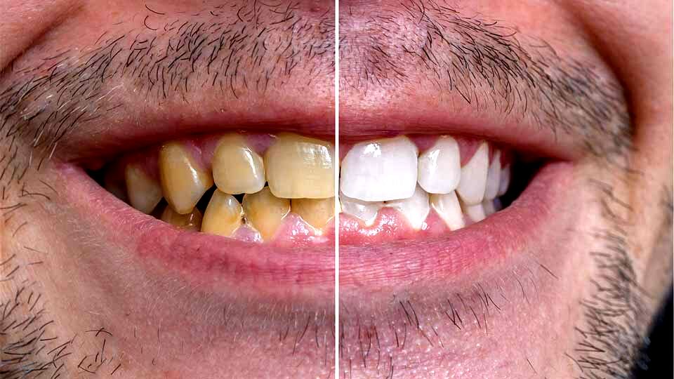 ترفند آسان برای رفع جرم دندان 