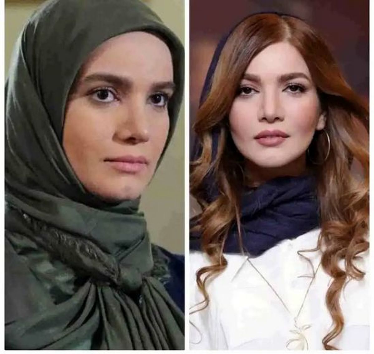 متین ستوده قبل و بعد از عمل زیبایی